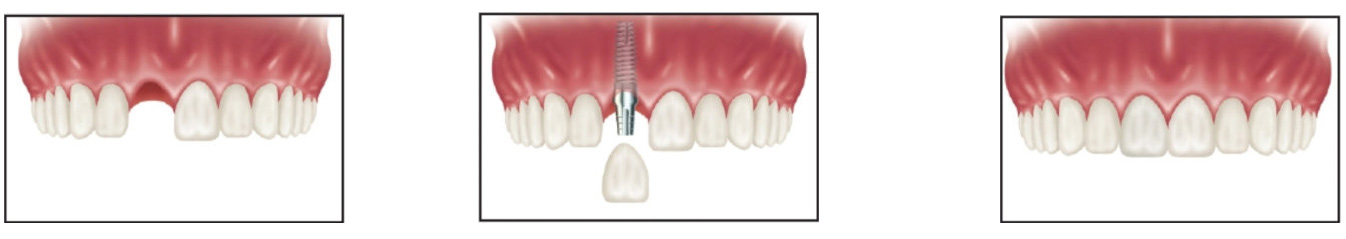 ایمپلنت دندان تک دندان