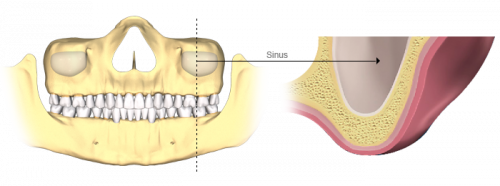 تحلیل استخوان فک ناشی از افتادن چند دندان