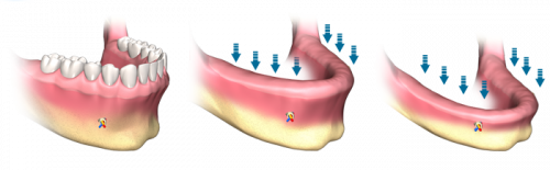  استخوان فک کل قوس دندان
