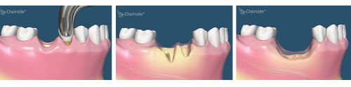 تحلیل رفتن استخوان فک پس از کشیدن دندان