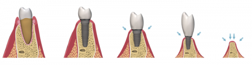 کشیدن دندان برای محافظت از استخوان فک