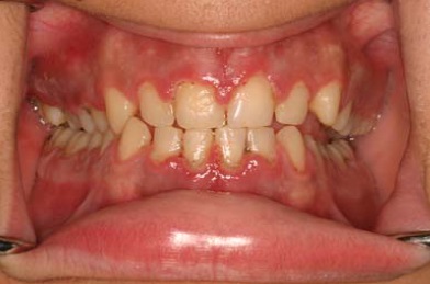 علت ورم لثه پشت دندان