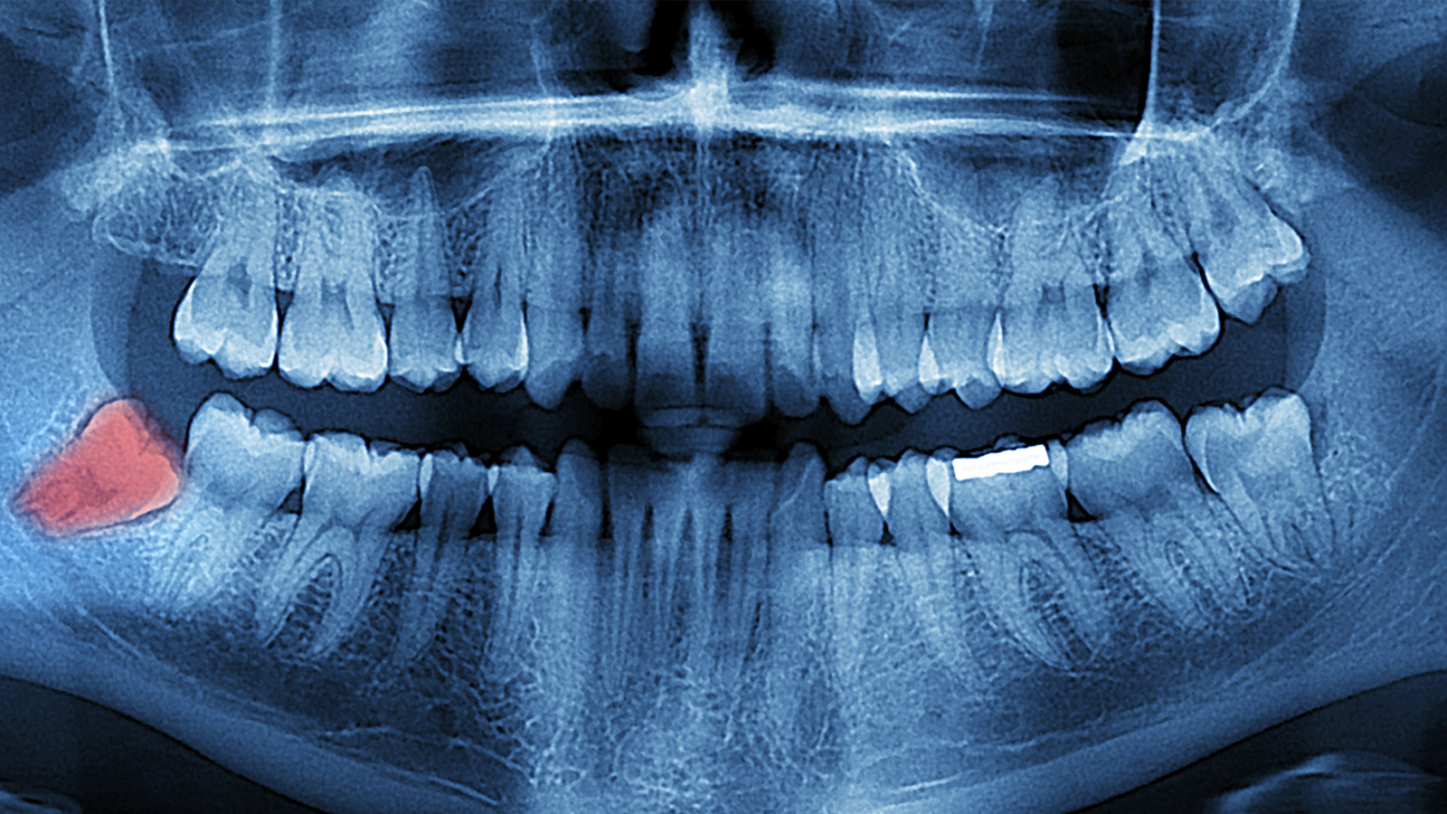 عکس اشعه ایکس دندان