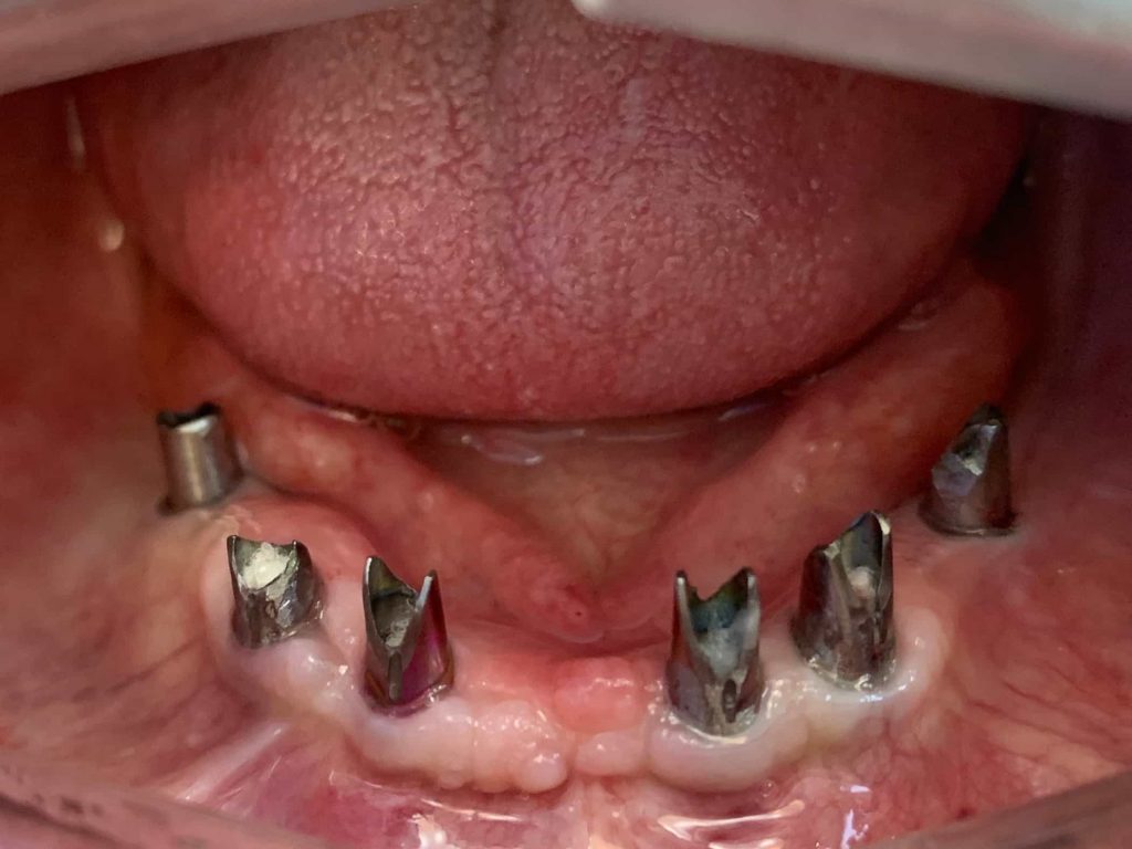 کاشت ایمپلنت دندان 2