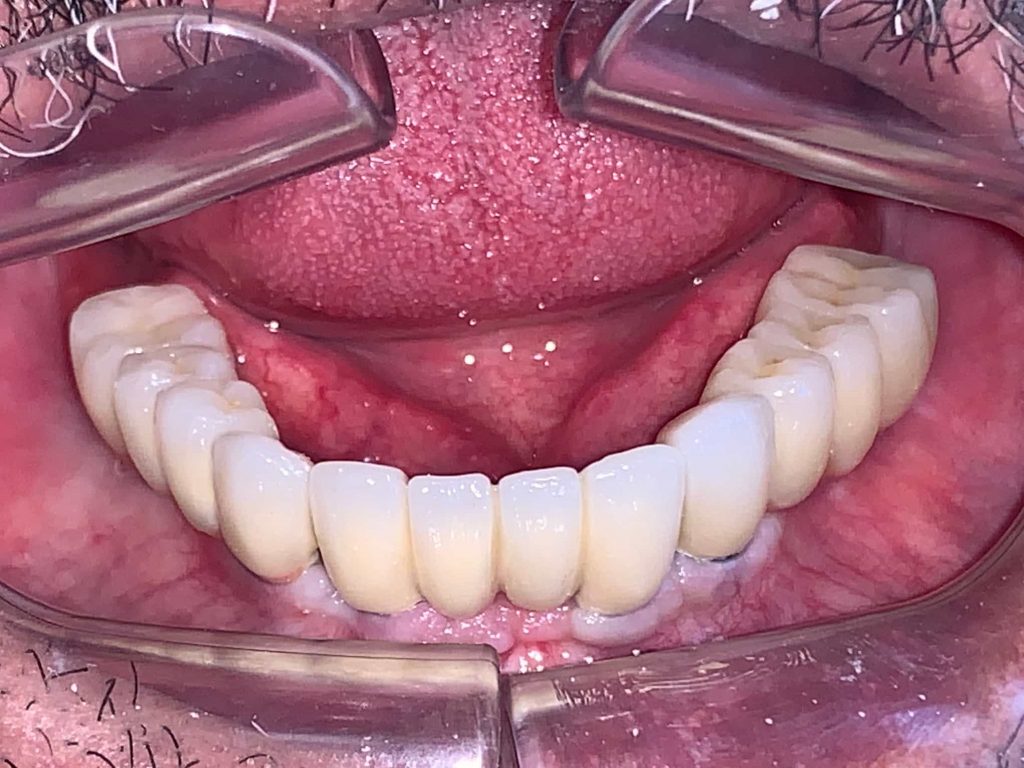 کاشت ایمپلنت دندان 3