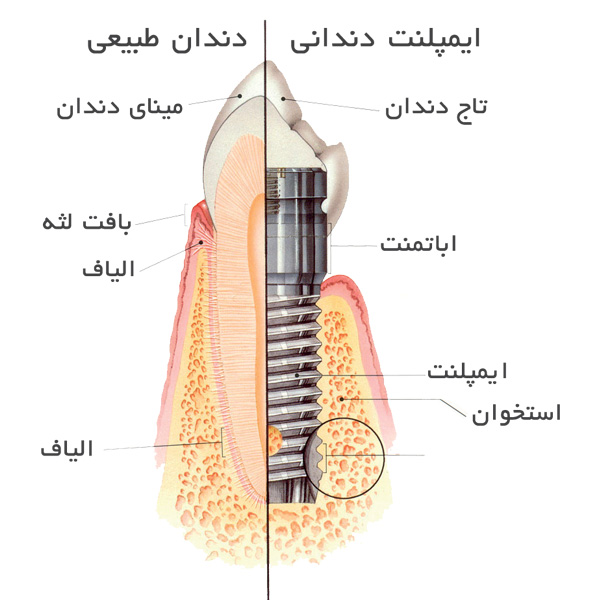 مقایسه دندان طبیعی و ایمپلنت