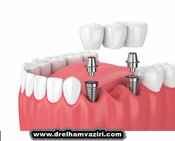 فواید ایمپلنت دندان در کلینیک دکتر الهام وزیری