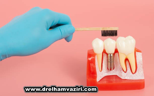 مراحل درمان ایمپلنت دندان