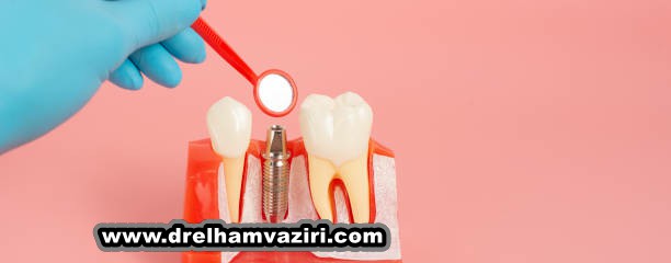 مواردی که باید در مورد ایمپلنت دندان بدانید
