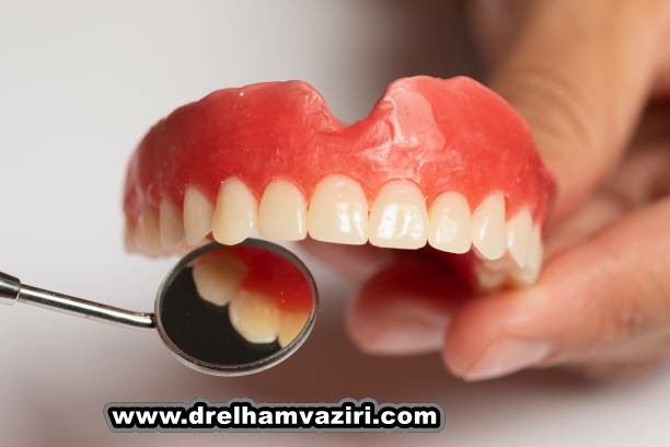 ایمپلنت دندان بهترین راه حل جایگزینی دندان