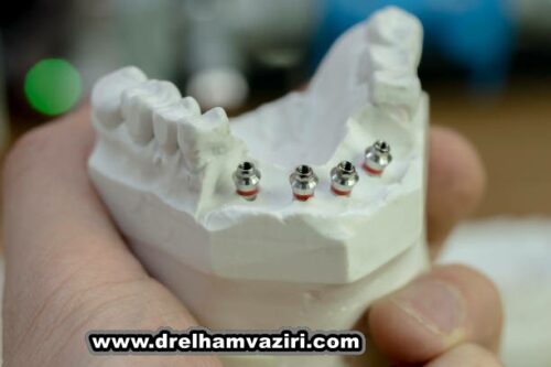 بهبودی از ایمپلنت دندان