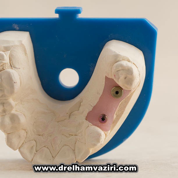 آرام بخشی برای ایمپلنت دندان
