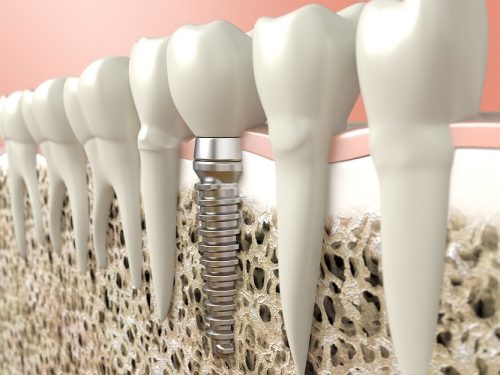 پوکی استخوان و کاشت ایمپلنت دندان