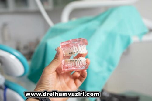 ایمپلنت دندان در کلینیک دکتر وزیری چیست؟