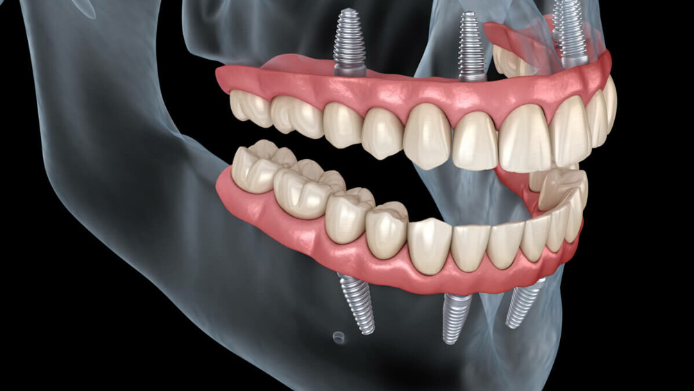 ابعاد و اندازه ایمپلنت دندان