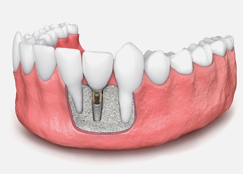 پیوند استخوان قبل از ایمپلنت دندان