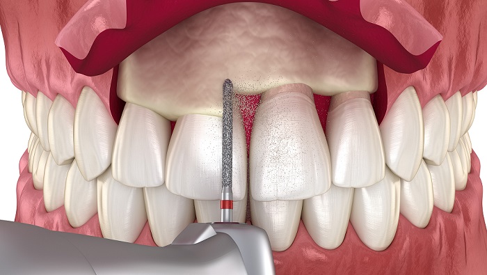 روش های جراحی و زیاد کردن طول تاج دندان