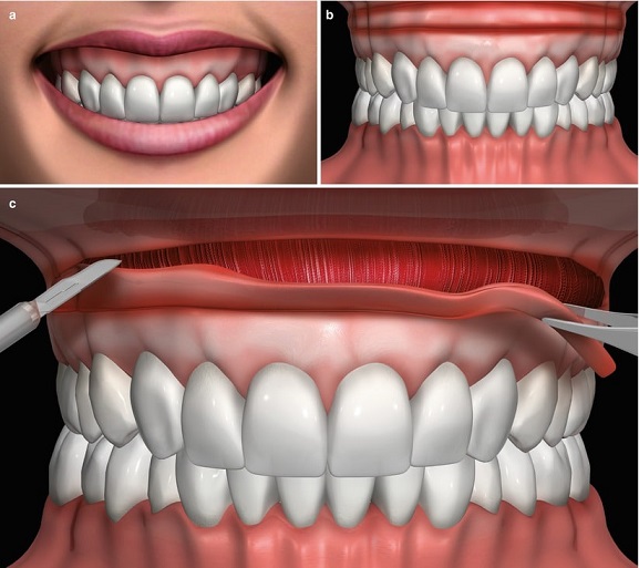 افزایش طول تاج دندان چیست؟