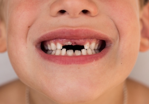 عوراض بی دندانی چیست