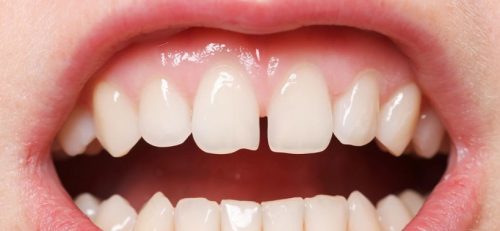 فاصله بین دندان ها