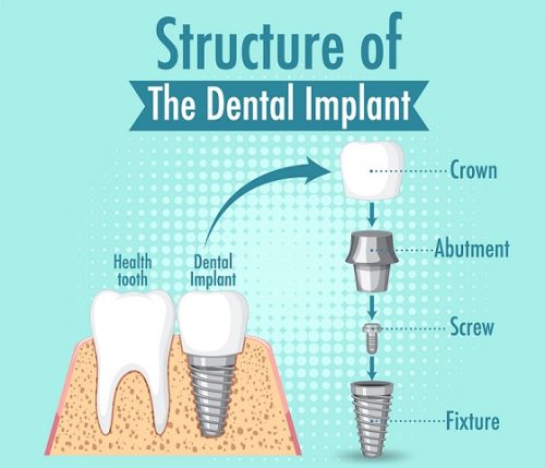 ساختار ایمپلنت دندان