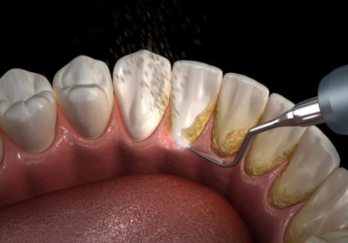 جرمگیری ایمپلنت دندان