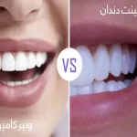 سرامیک دندان بهتر است یا کامپوزیت