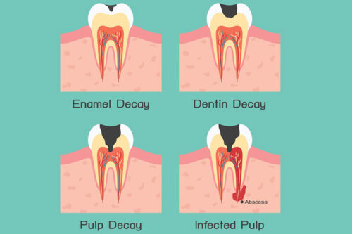 نشانه‌ها-و-علائم-پوسیدگی-دندان
